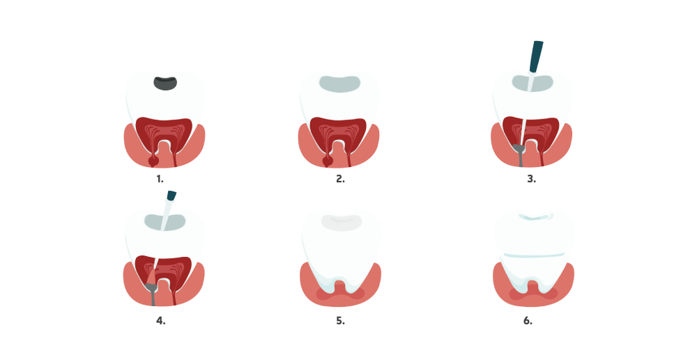Dantų šaknų kanalų gydymo etapai
